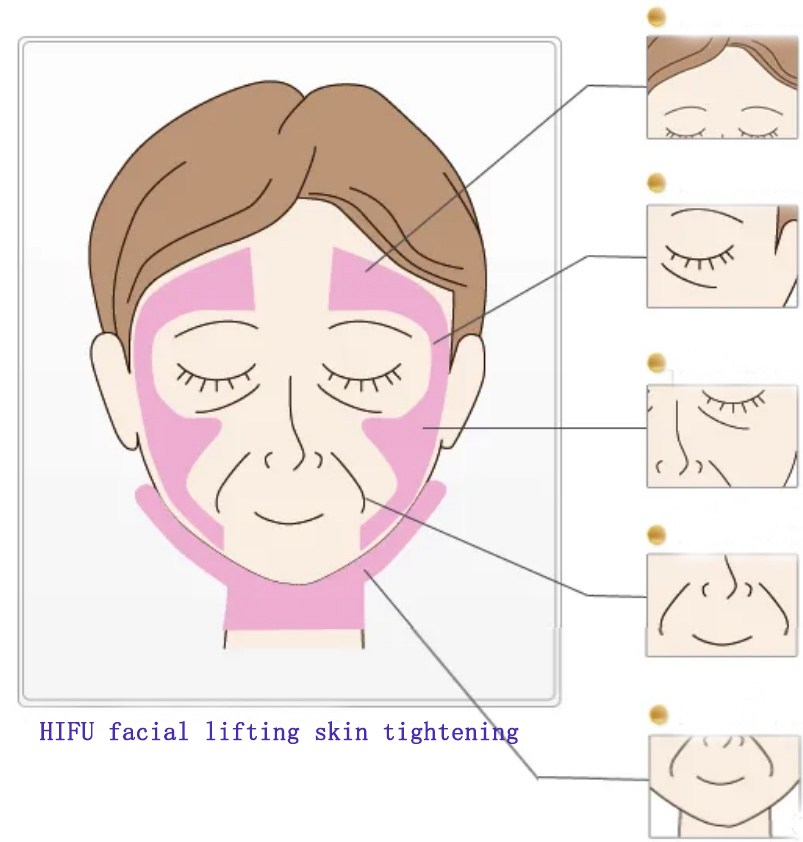 피부 손상을 피하기 위해 Hifu 페이셜 리프팅 처리 전에 치료 라인을 그리는 방법?